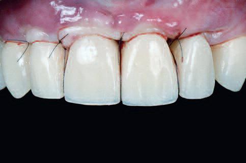 Во время того, как пациент находился на ортодонтическом лечении, решено сделать новый полимерный протез с винтовой фиксацией, чтобы достичь идеальных условий для установки двух имплантатов на замену 24/25 зубов, а также отодвинуть во времени выполнение финальных керамических реставраций до окончания процесса остеоинтеграции