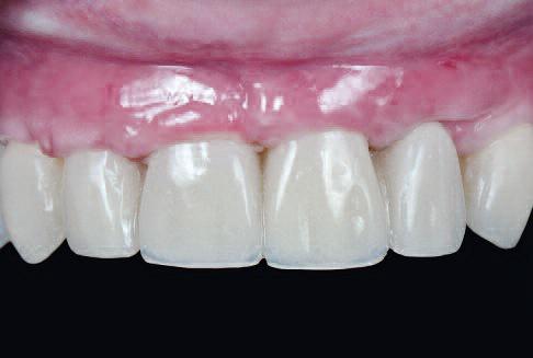 Во время того, как пациент находился на ортодонтическом лечении, решено сделать новый полимерный протез с винтовой фиксацией, чтобы достичь идеальных условий для установки двух имплантатов на замену 24/25 зубов, а также отодвинуть во времени выполнение финальных керамических реставраций до окончания процесса остеоинтеграции