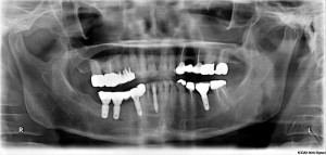 Стоматологический анамнез: атрофия альвеолярного гребня нижней челюсти в результате длительного испо­­­­­льзования частичного зубного протеза