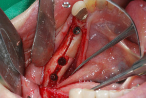 В области зуба 46 произошел перелом язычной кортикальной пластинки по типу «ивового прутика»; фрагменты неподвижны